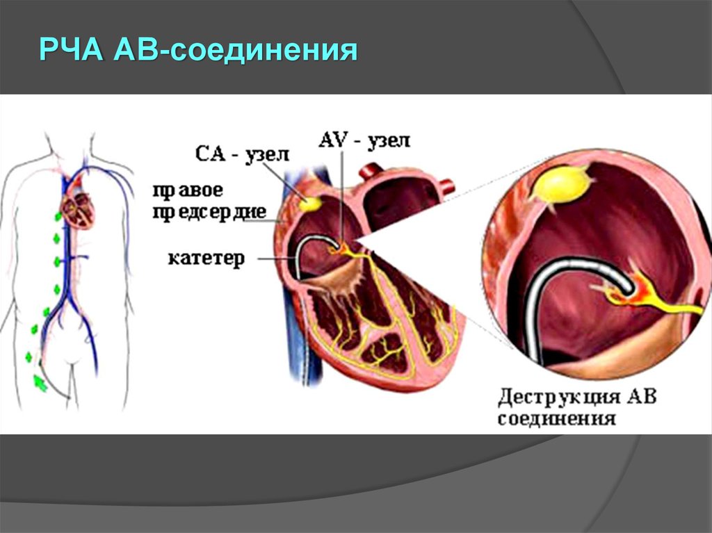 Абляция сердца при мерцательной. Радиочастотная абляция аритмия. Предсердий катетерная абляция. Радиочастотная катетерная абляция экстрасистолия.