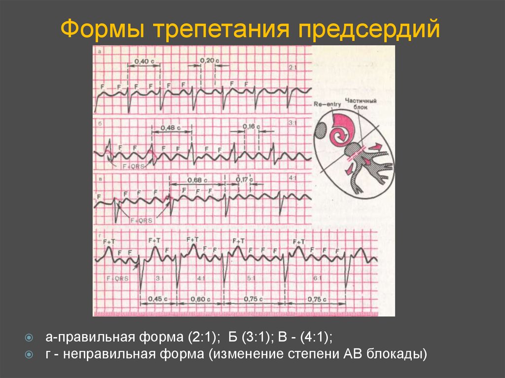 Формы трепетания предсердий. Трепетание предсердий неправильная форма на ЭКГ. Правильная форма трепетания предсердий на ЭКГ. Фибрилляция предсердий правильная форма на ЭКГ. Трепетание предсердий типы 1 и 2.