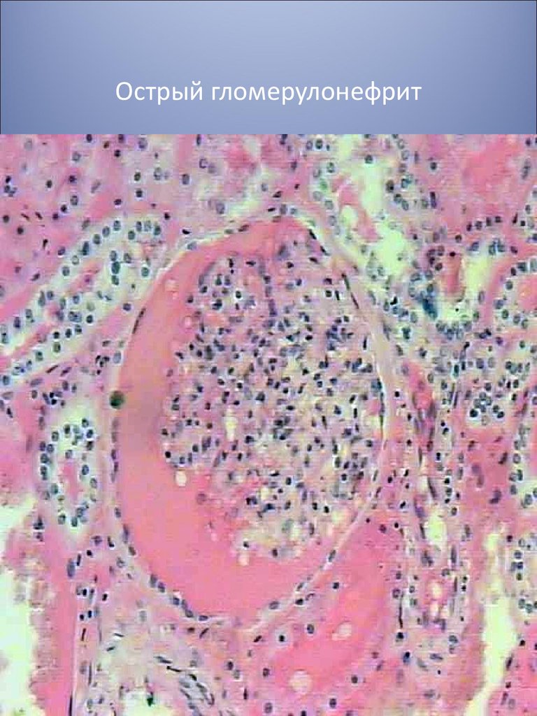 Острый гломерулонефрит презентация