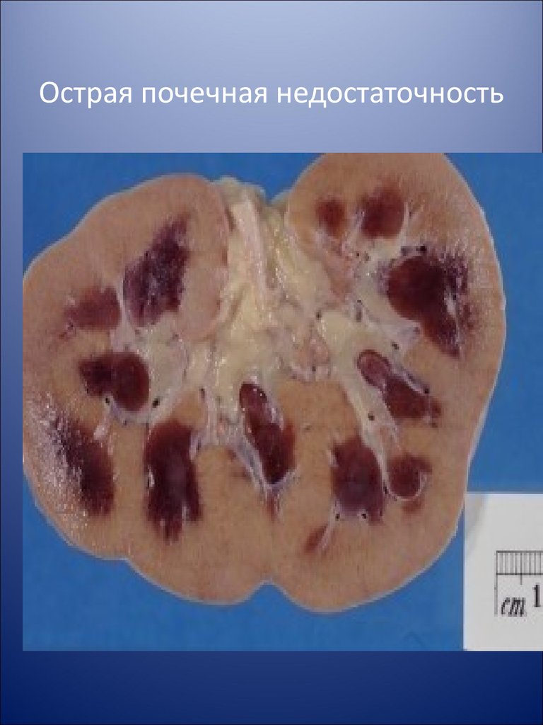Острый гломерулонефрит картинки