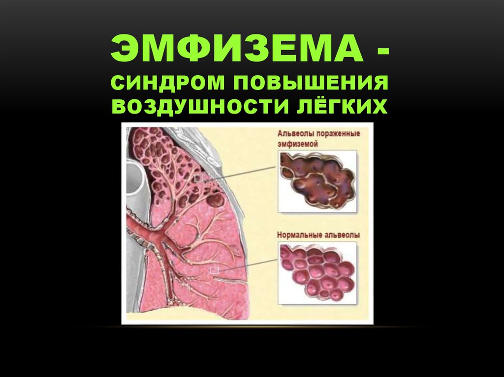 Синдром повышение. Синдром эмфиземы лёгких. Синдром воздушности легочной ткани.