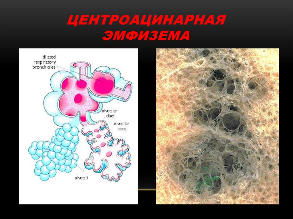 Легкие при хобл картинки