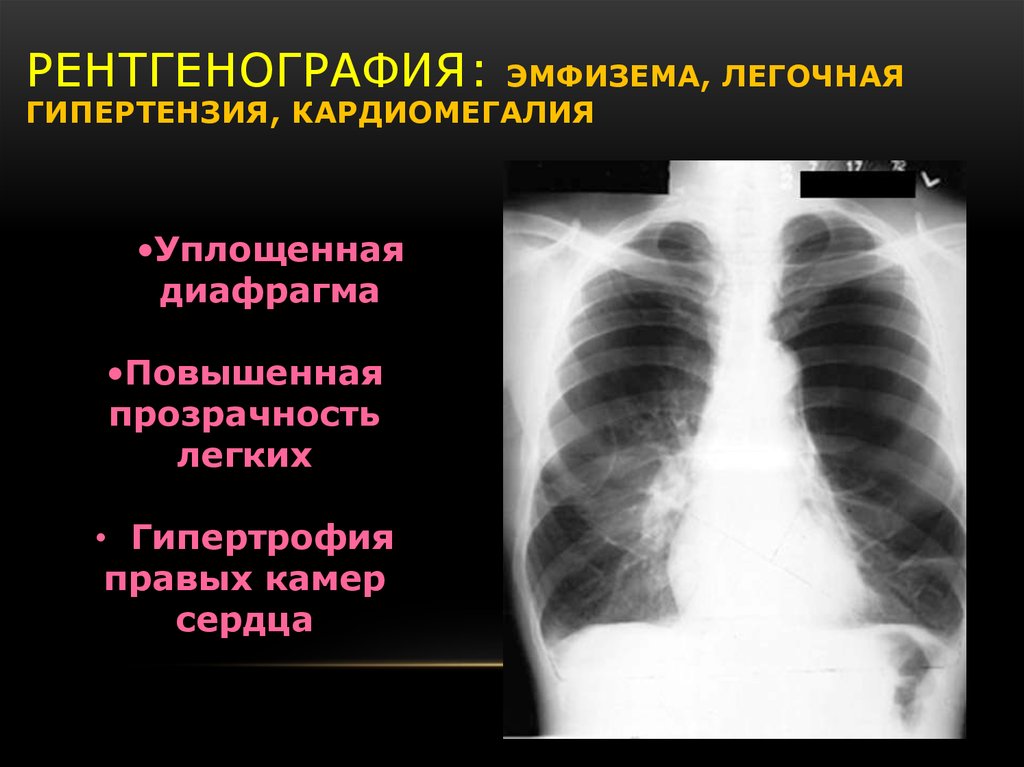 Отсутствие легочного рисунка на рентгене