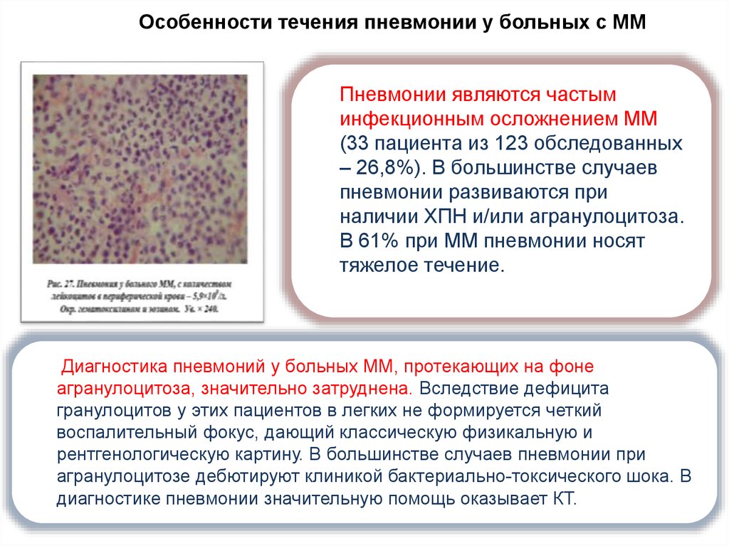 Множественная миелома 3