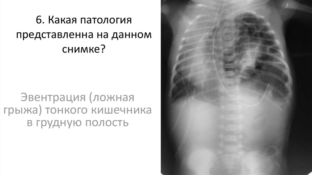 Эвентрация. Ложная диафрагмальная грыжа. Дислокация кишечника в грудную полость. Эвентрация желудка в грудную полость.