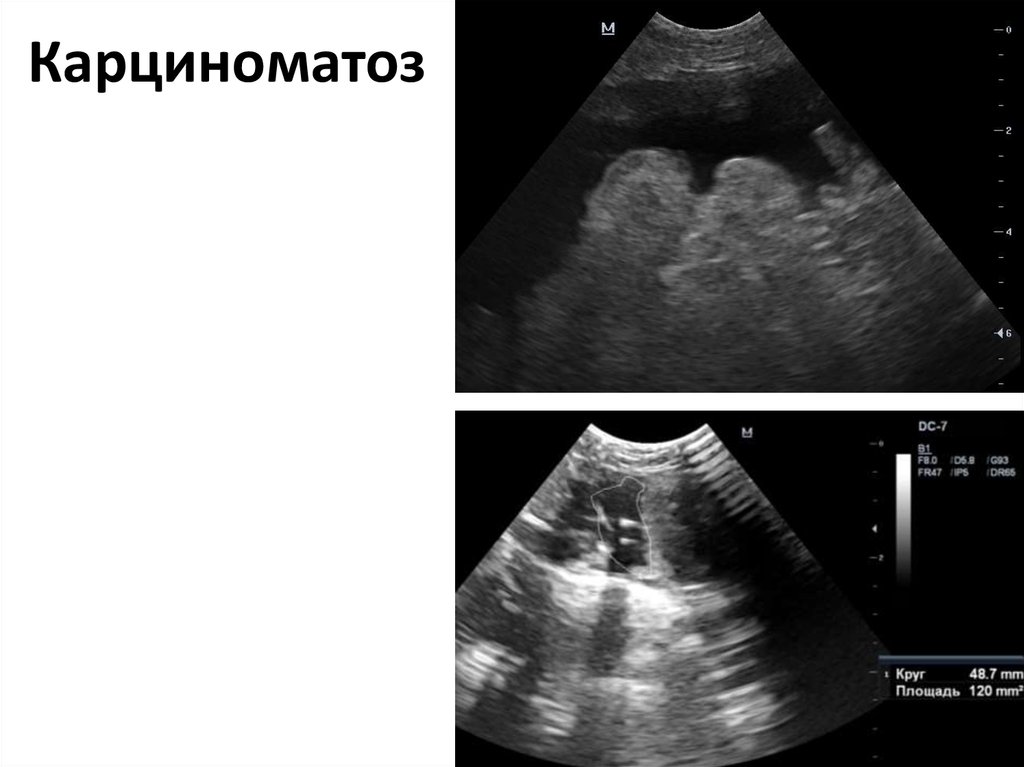 Карциноматоз