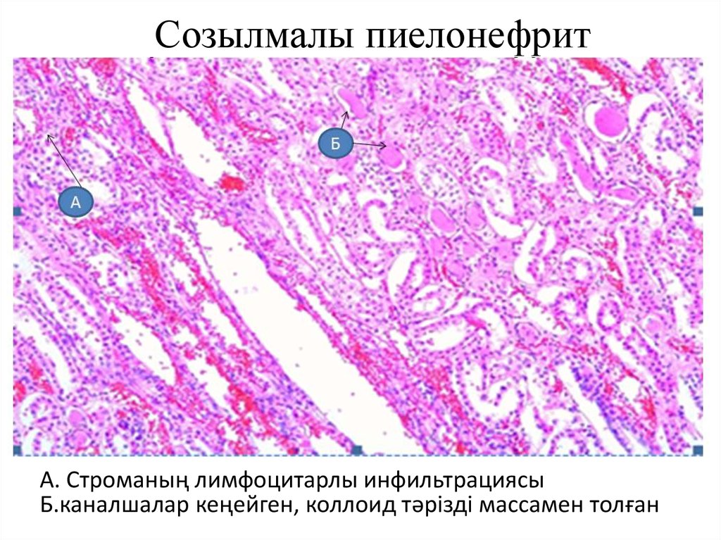 Созылмалы гломерулонефрит презентация