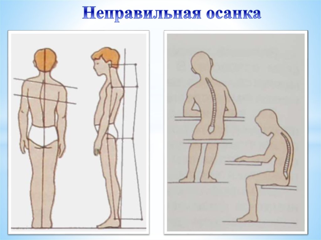 Рассмотрите рисунки 1 4 на каком из них изображен подросток с нормальной осанкой