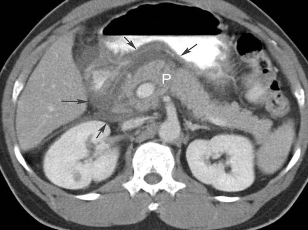 Кт признаки поджелудочной железы. Хронический панкреатит кт. Подострый панкреатит кт. Патологии поджелудочной железы на кт. Компьютерная томография поджелудочной железы.