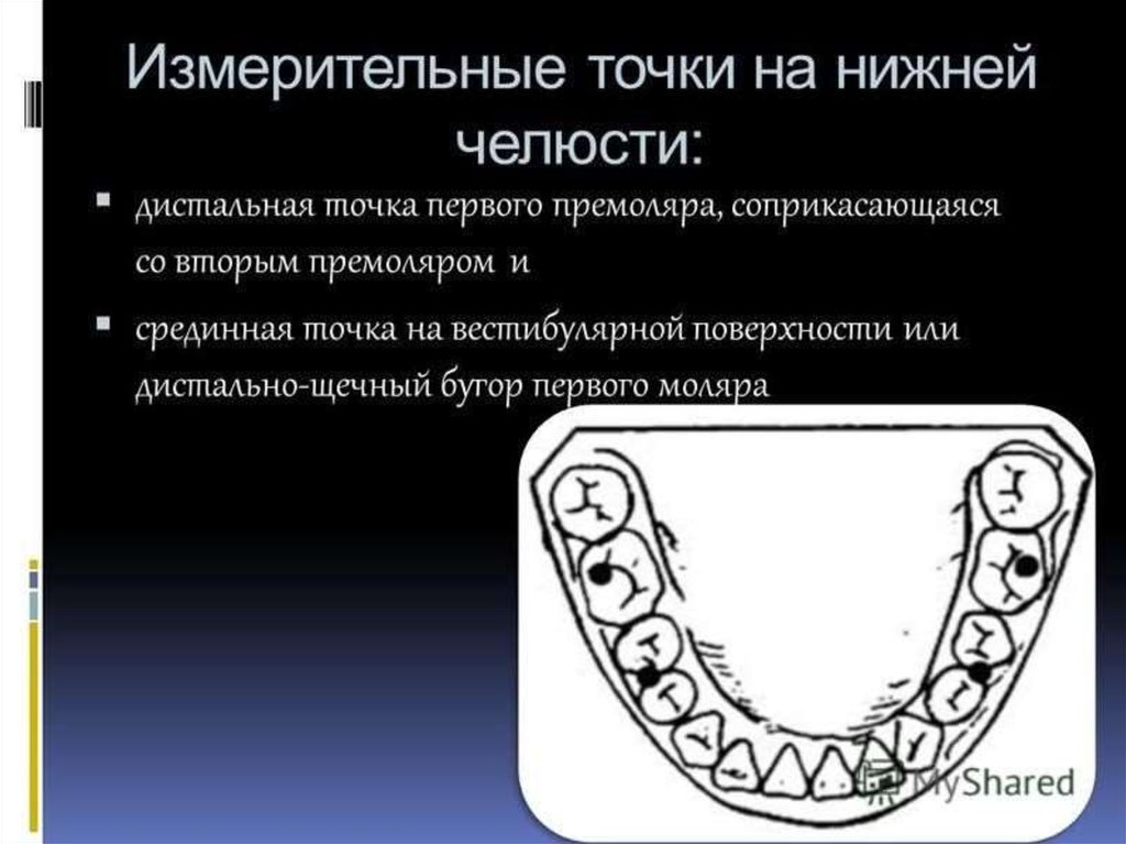 Метод пона. Исследование на диагностических моделях челюстей. Измерительная точка пона на нижних первых премолярах. Точки пона на нижней челюсти. Измерительные точки по пону.