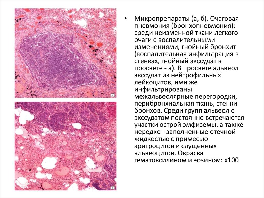 Очаговая пневмония рисунок микропрепарат