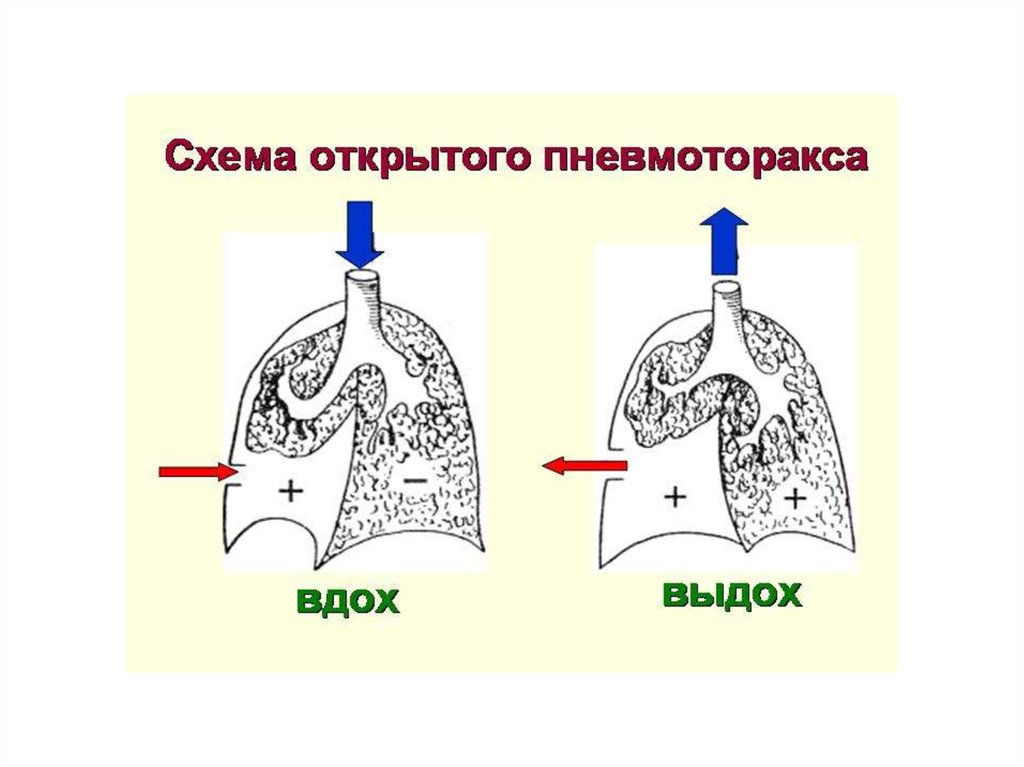 Клапанный пневмоторакс презентация