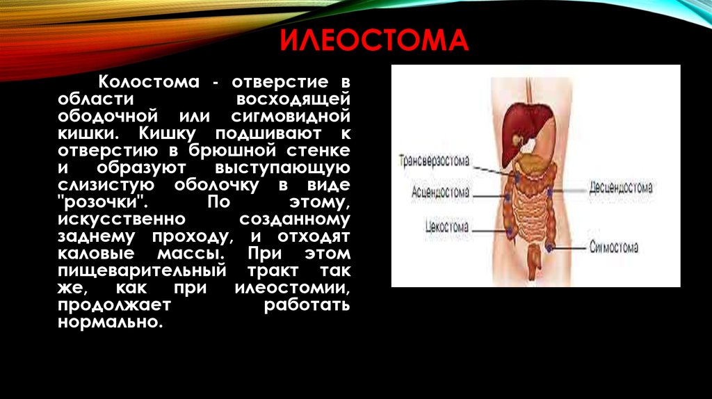 Колостома карта вызова