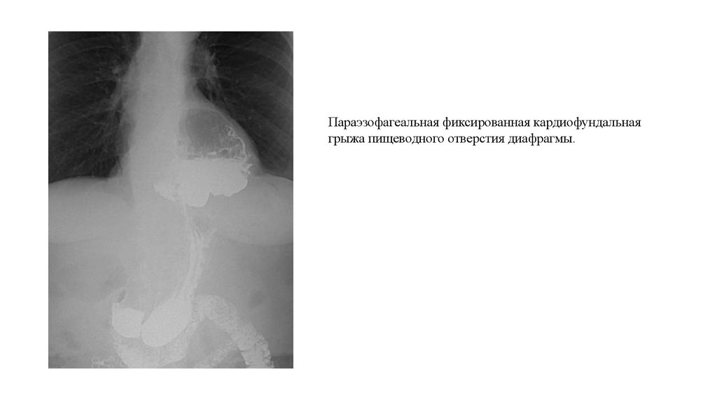 Грыжа пищеводного отверстия диафрагмы симптомы фото