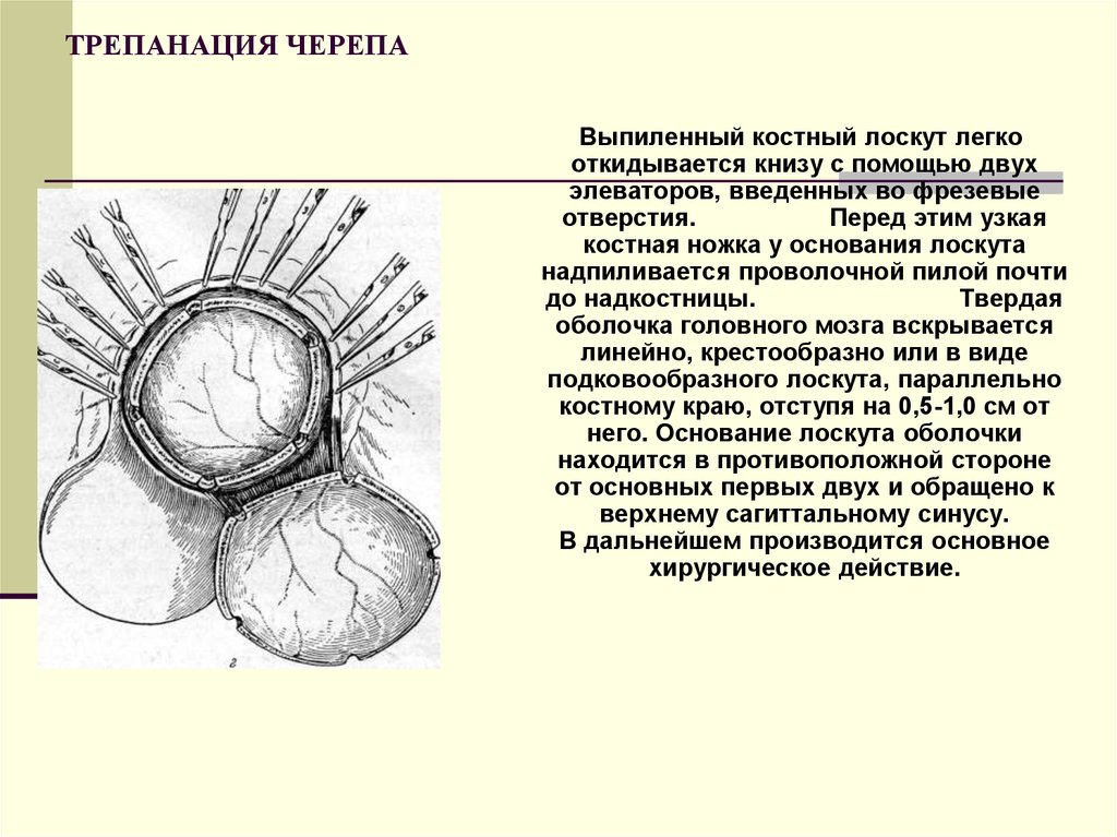 Костно пластическая трепанация черепа презентация