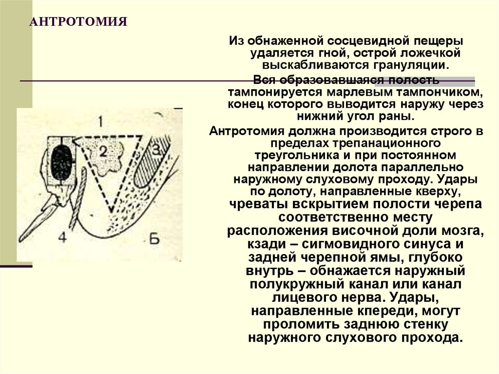 Треугольник шипо