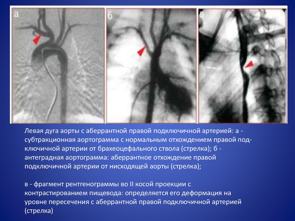 Правая аберрантная артерия. Аномалии отхождения подключичной артерии. Аберрантная почечная артерия кт. Аберрантная правая подключичная артерия. Аберрантная дуга аорты.