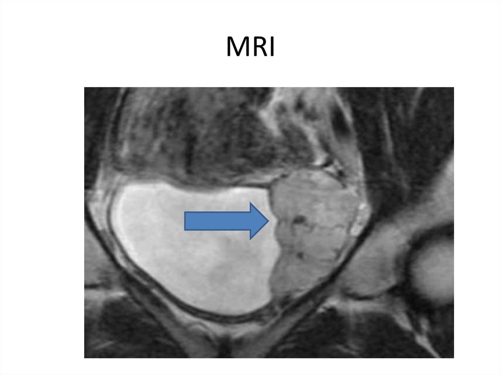 MRI