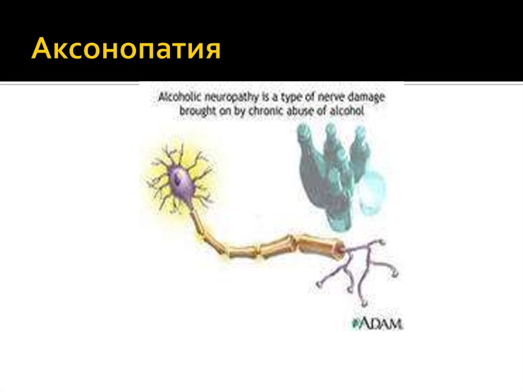 Аксонопатия. Аксонопатия и миелинопатия. Аксональные полиневропатии. Аксональная дегенерация.
