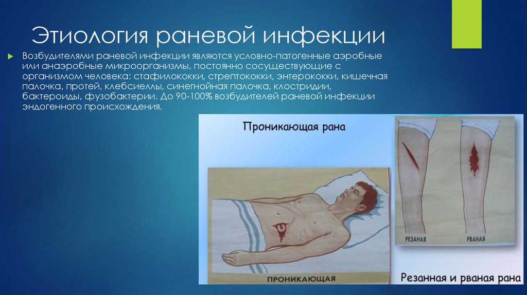 Этиология раневой инфекции