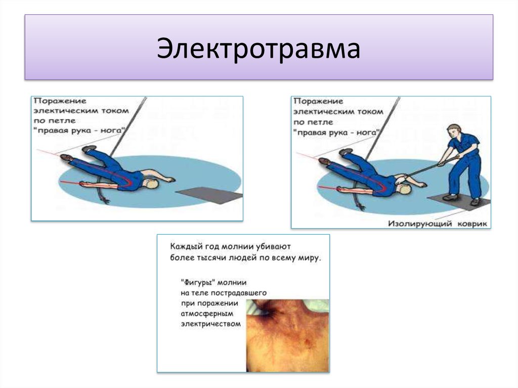 Виды электротравм. Петля тока при электротравме. Электротравма это определение. Электротравма конечности.