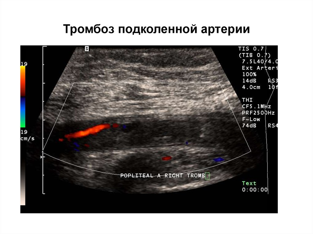 Доплер нижних. Эмболия подколенной артерии УЗИ. Тромбоэмболия бедренной артерии УЗИ. Тромбоз поверхностной бедренной артерии на УЗИ. Острый артериальный тромбоз УЗИ.