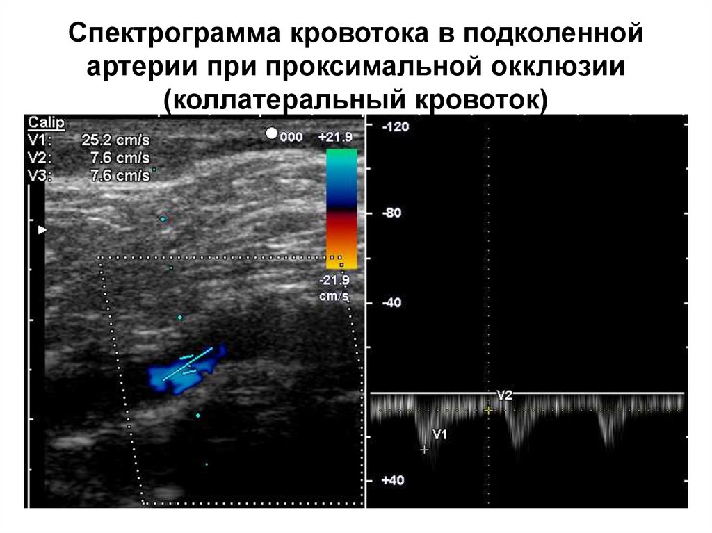 Узи нижних конечностей изранов. Магистральный и коллатеральный Тип кровотока на УЗИ. Типы артериального кровотока на УЗИ.