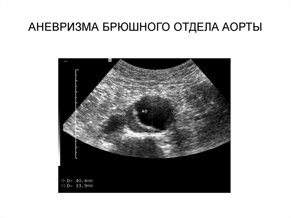 Аневризма брюшной аорты узи признаки и фото с описанием