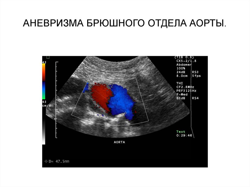 Аорта норма узи. Расслаивающая аневризма брюшной аорты УЗИ. УЗИ аневризмы брюшной аорты. Аневризма брюшной аорты УЗИ классификация. УЗИ брюшного отдела аорты.