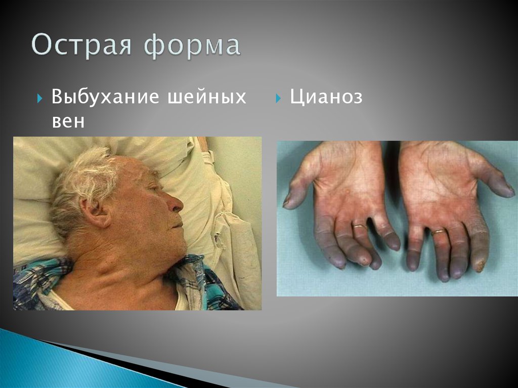 Острая форма