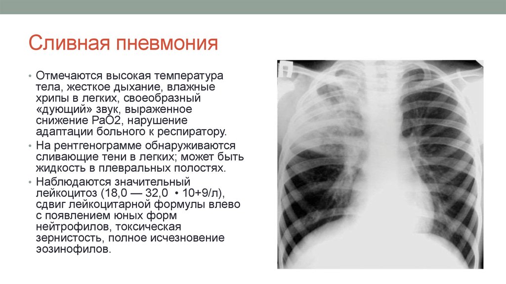Осложнения очагов пневмонии. Двухсторонняя сливная пневмония. Рентген при очагово сливная пневмония. Очагово сливная пневмония у детей рентген. Очаговая левосторонняя пневмония сливная.