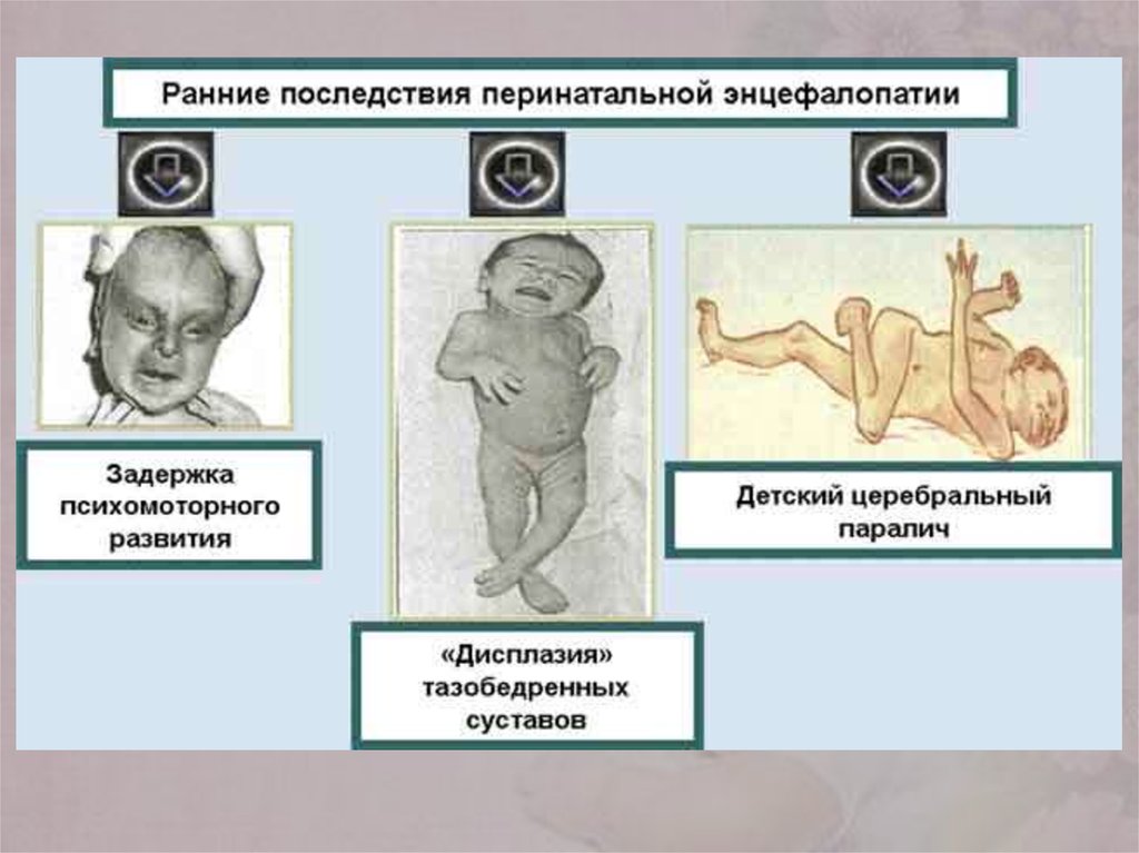 Энцефалопатия у детей