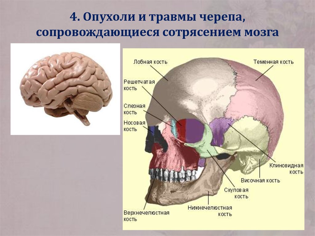 Сотрясение черепа. Новообразования на черепе. Объемное образование черепа.