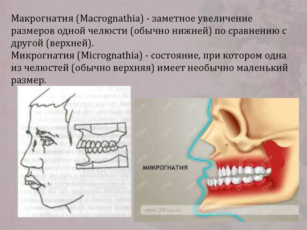 Лечение нижней челюсти. Макрогнатия верхней челюсти и нижней челюсти. Верхнечелюстная макрогнатия. Макрогнатия и микрогнатия. Макрогнатия верхней челюсти и микрогнатия нижней.