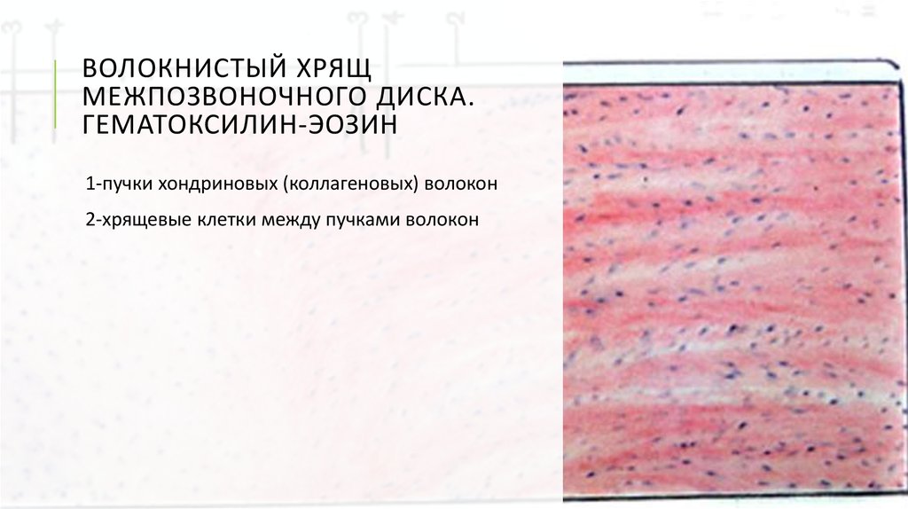 Субплевральный узел незрелой хрящевой ткани. Хрящ межпозвоночного диска гистология. Волокнистая хрящевая ткань гематоксилин и эозин. Волокнистый хрящ межпозвоночного диска теленка препарат. Волокнистая хрящевая ткань препарат.