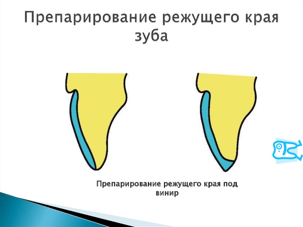 Препарирование под металлокерамическую коронку с уступом в картинках