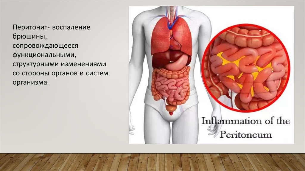 Перитонит у детей презентация