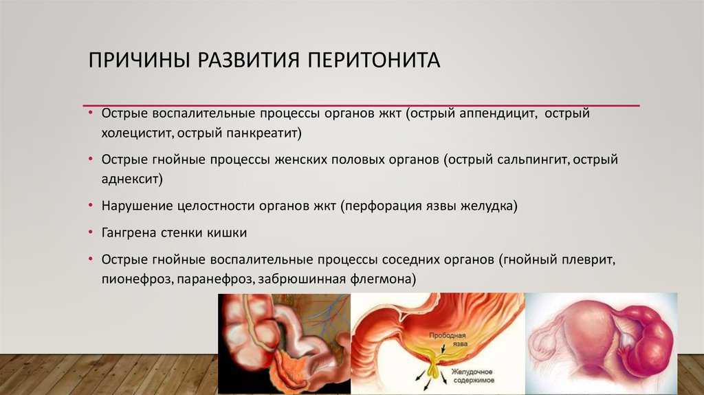 Перитонит госпитальная хирургия презентация