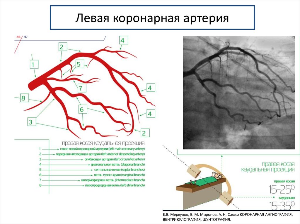 Рисунок коронарные артерии