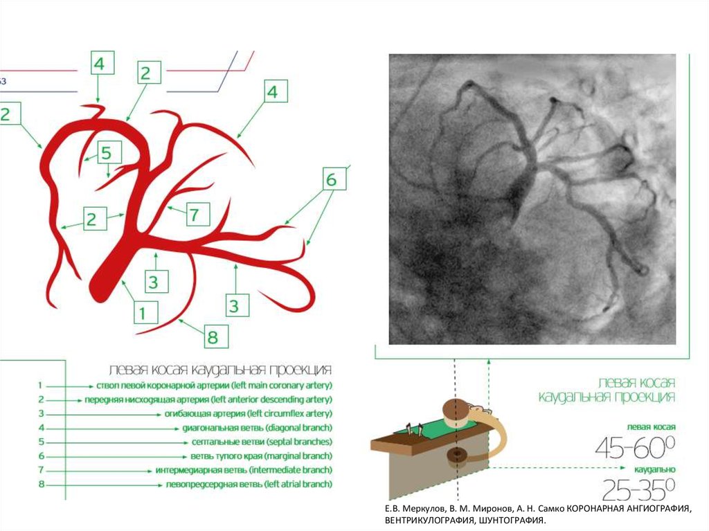 Сосуды сердца схема коронарография