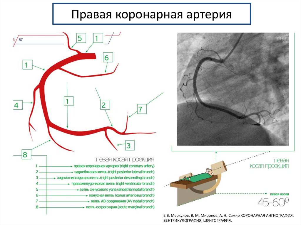 Коронарные артерии где находятся у человека фото