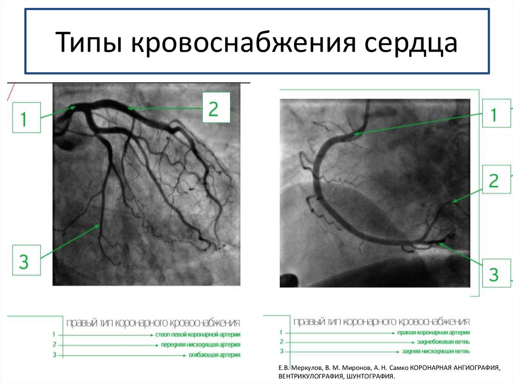 Сосуды сердца схема коронарография