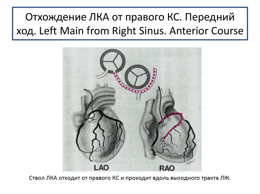 Передний ход. Аномалия отхождения левой коронарной артерии. Врожденные аномалии отхождения коронарных сосудов. Аномальное отхождение левой коронарной артерии. Аномальное отхождение правой коронарной артерии.