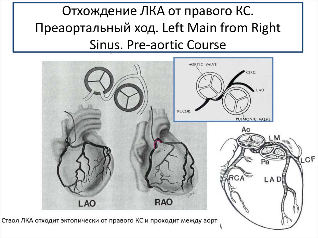 Левая коронарная артерия. Ретроаортальный ход левой коронарной артерии. Отхождение правой и левой коронарной артерии. Синусы Вальсальвы коронарные артерии. Аномальное отхождение коронарных артерий от аорты.