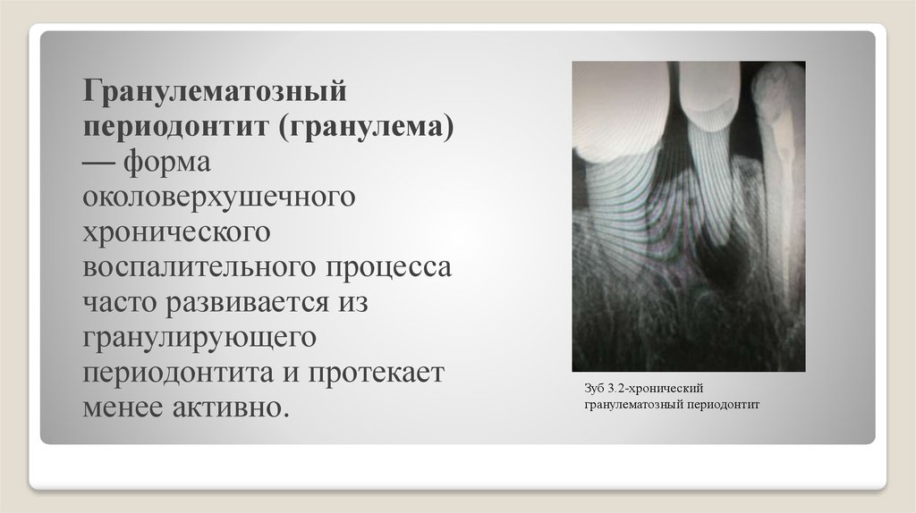 Хронический гранулирующий периодонтит мкб