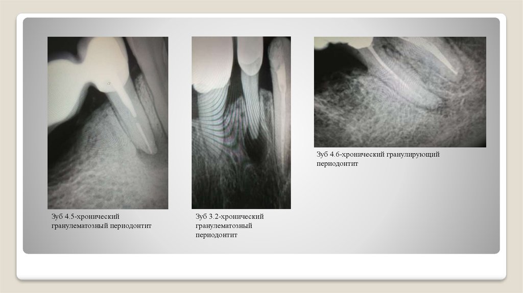 Хронический гранулирующий периодонтит план лечения