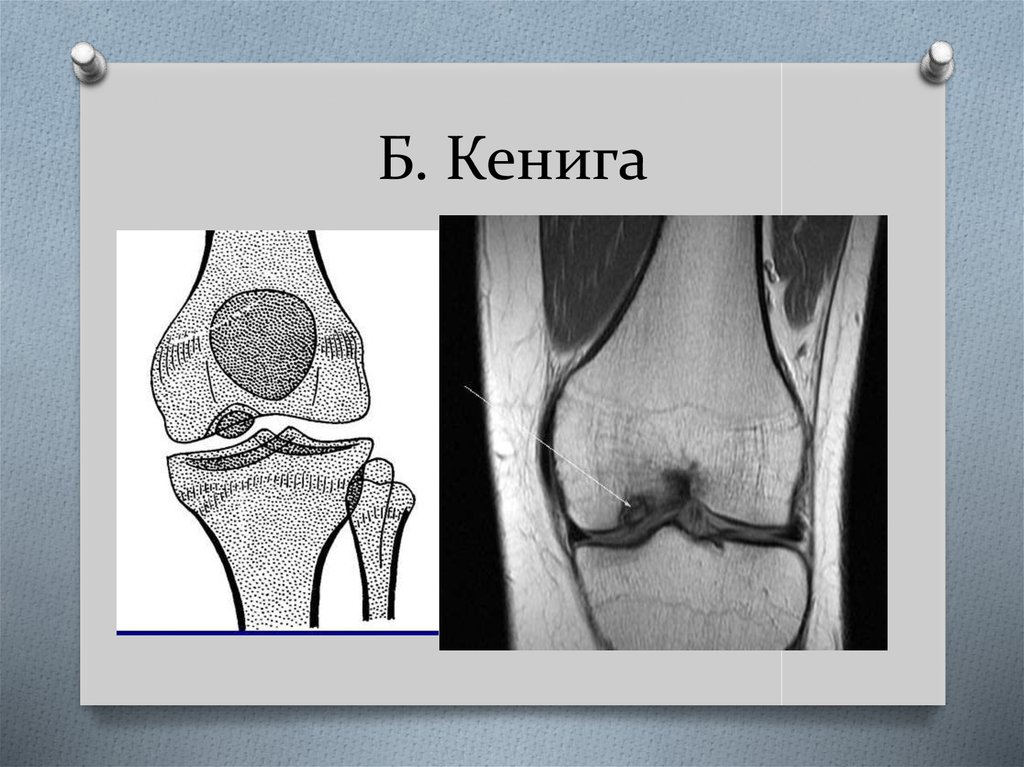 Болезнь кенига коленного сустава. Болезнь Кёнига рассекающий остеохондрит. Остеохондропатии Кенига. Кенига болезнь коленного сустава на рентгене. Рассекающий остеохондрит коленного сустава.