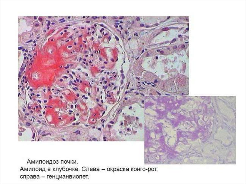 Амилоидоз почек презентация