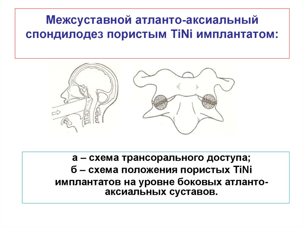 Атланто аксиальное сочленение