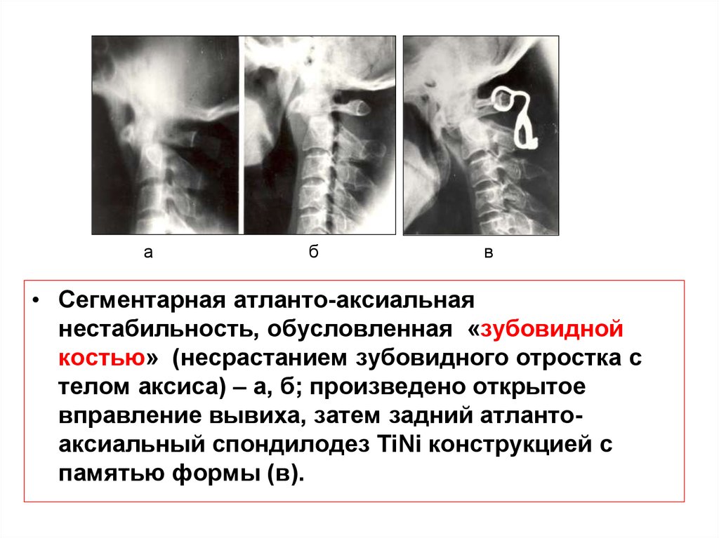 Атланто аксиальное сочленение